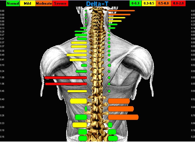 Chiropractic Princeton NJ Tytron Scan